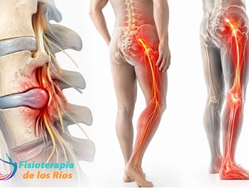 💥 Radiculopatía lumbar: síntomas, causas y el tratamiento más eficaz para aliviar el dolor