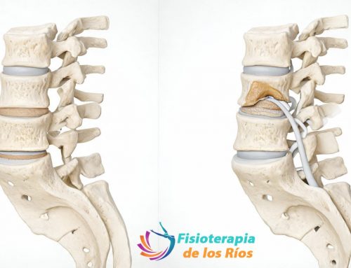 💥 Discopatía degenerativa y hernia discal: cómo diferenciarlas y tratarlas eficazmente